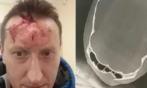Mężczyzna z raną głowy i szwami na czole, obok zdjęcie RTG czaszki ukazujące poważne obrażenia, prawdopodobnie spowodowane przez kastet.
