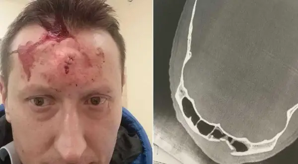 Mężczyzna z raną głowy i szwami na czole, obok zdjęcie RTG czaszki ukazujące poważne obrażenia, prawdopodobnie spowodowane przez kastet.