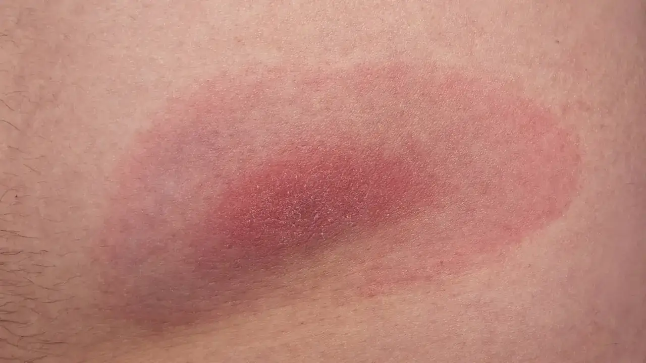 Rumień po ugryzieniu kleszcza miękkiego, rozległy, czerwony, z widocznym złuszczaniem naskórka.