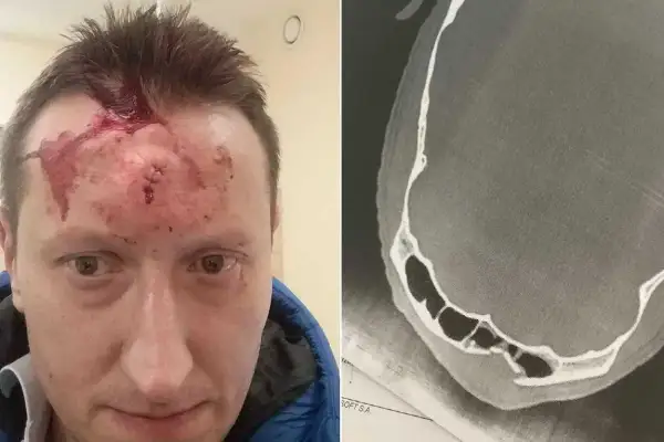 Mężczyzna z raną głowy i szwami na czole, obok zdjęcie RTG czaszki ukazujące poważne obrażenia, prawdopodobnie spowodowane przez kastet.